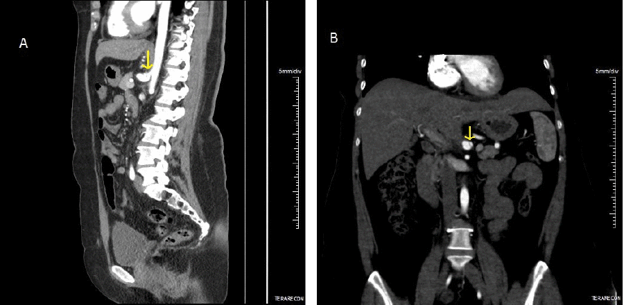 A) Improved compression of celiac artery and worsening post stenotic dilation (arrow); B) stable celiac dissection (arrow).