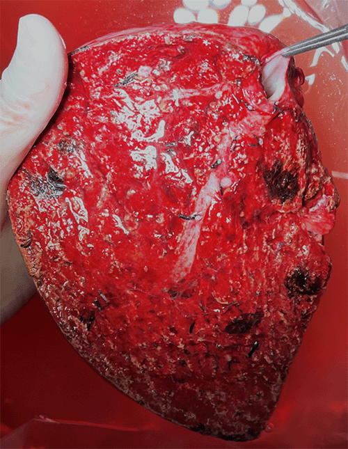 Right hepatic vein clearly visible on the transection surface