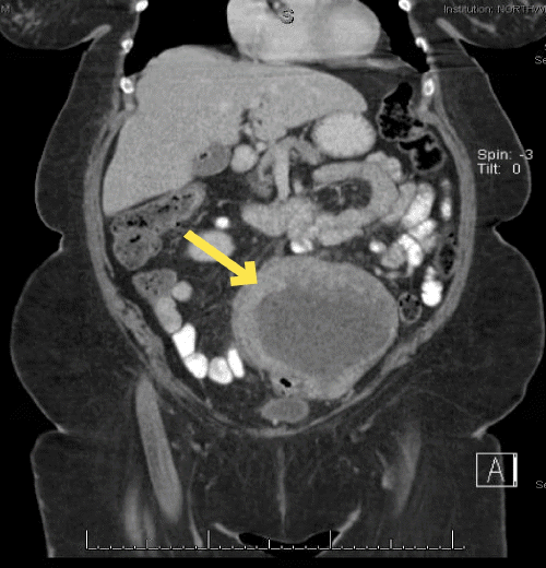 B) Necrotic mass demonstrating adherence to the colon (yellow arrow)