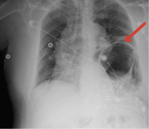 Delayed Traumatic Diaphragmatic Hernia Masquerading as COPD Exacerbation | ACS Delayed Traumatic Diaphragmatic Hernia Masquerading as COPD Exacerbation | ACS