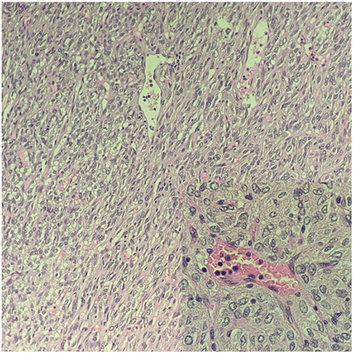 Tumor cells are arranged in patternless, fascicular, whorled, storiform, and palisading patterns. The cytoplasm is moderate, spindly, and amphophilic to clear, with defined cellular borders. Mitotic activity 5-7/50 HPF seen. Stroma is scant and collagenous with mild lymphoplasmacytic infiltrate seen. Foci of hemorrhages and coagulative necros noted. Tumor has rich vascularity