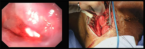 Figure 4. Intraoperative image showing dissection of the superior aspect of the diverticulum. The view on the left is through the endoscope which is retroflexed into the diverticulum, looking towards the apex. The view on the right shows the superior portion of the diverticulum being retracted away from the esophagus.