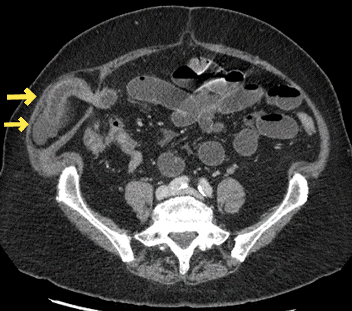 Note compression of the herniated ileum and free fluid within the hernia sac