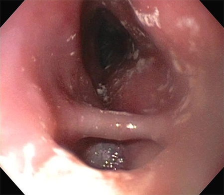 Figure 3. Image of the EGD that shows the entrance to the smaller, distal diverticulum with the lumen of the esophagus in the background.
