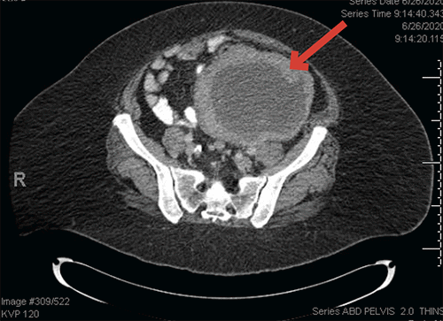 A) Note large, centrally necrotic mass in the left lower quadrant (red arrow)