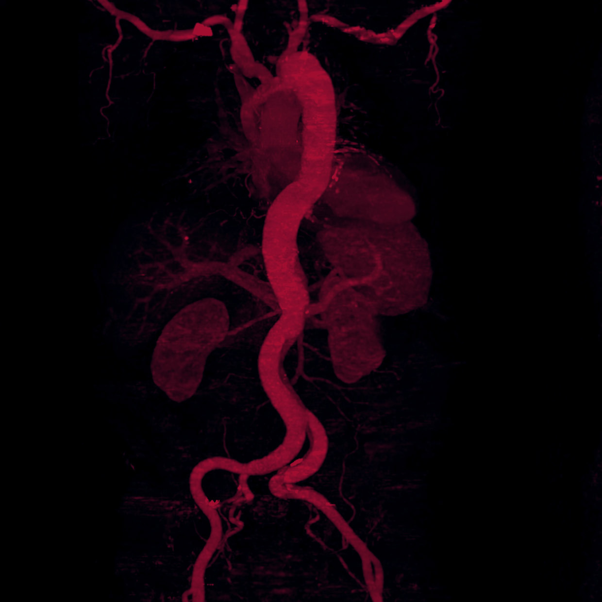 Smart Solutions  Are Transforming Aortic Dissection Diagnosis and Repair