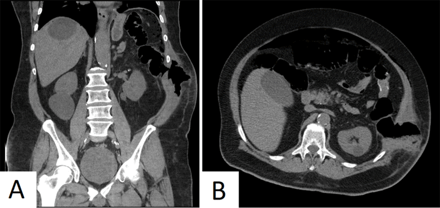 Note colonic perforation into abdominal wall and intraperitoneal contamination in A) coronal plane and B) axial plane
