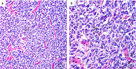 Figure 2. (a) Low-power H&E depicts low-grade pancreatic neuroendocrine neoplasm composed of epithelioid cells forming nests, trabeculae, ribbons and rosettes that are separated by thin fibrovascular septa. (b) High-power H&E shows the nuclei mildly atypical with no significant mitotic activity. 