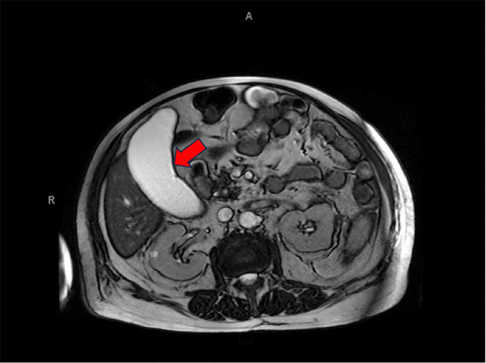 MRCP image confirming marked gallbladder distension (hydrops, red arrow). The gallbladder measured approximately 13 cm in its maximum anterior-posterior dimension, and there was no evidence of biliary ductal obstruction