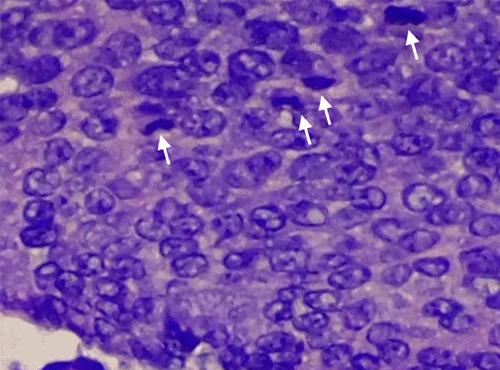 (D) High-power magnification reveals brisk mitotic figures (white arrows) within the basaloid cells