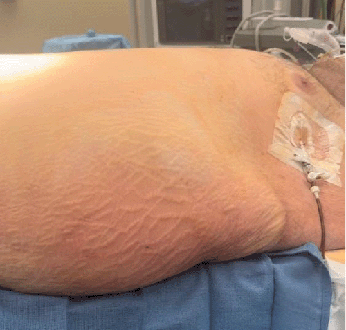 Clinical photograph showing marked skin changes (erythema, ecchymosis) overlying the left flank hernia and the drainage of frank succus entericus from a percutaneously placed Wayne pleural catheter