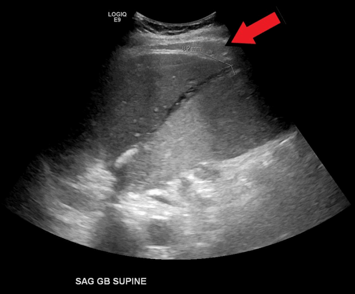 Figure 1. Ultrasound image demonstrating distended gallbladder with thickened wall and ascites. Arrow head shows the distended gallbladder. Arrow shows ascites. 