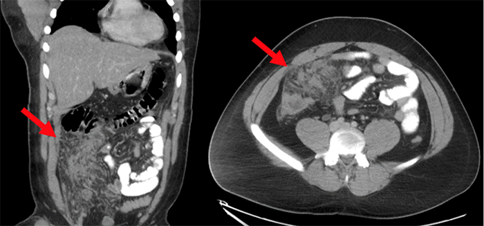 Coronal (left) and axial (right) views. Arrows indicate multifocal abutting soft tissue densities within the central right abdominal peritoneum