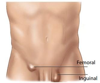Adult Inguinal and Femoral Groin Hernia Repair