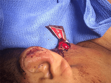 Figure 1. Foreign body protruding through left lateral neck zone 2.