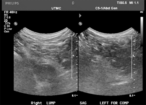 A) Hypoechogenic area in gluteal fold region, which appeared to herniate through defect with coughing and reduction. 