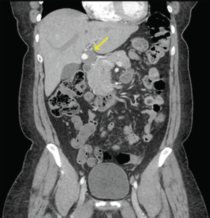 Hepatic Artery Aneurysms: An Uncommon Presentation of a Deadly Disease ...