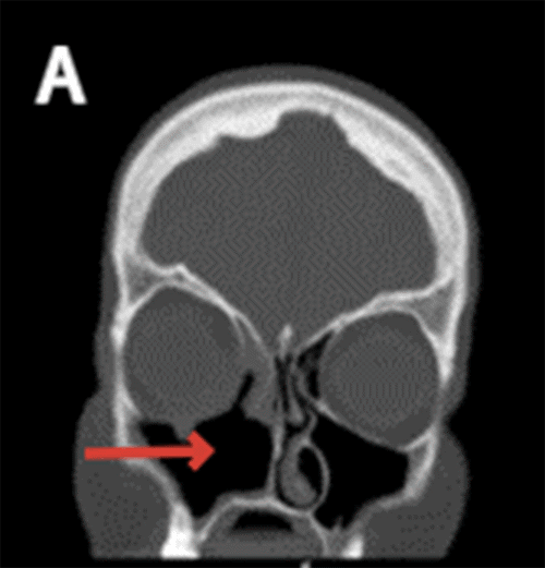 A) Arrow pointing at loss of medial wall of right maxillary sinus