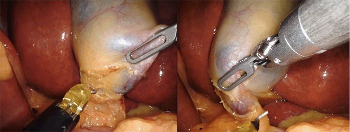 Infundibular approach with medial and lateral peritoneal dissection