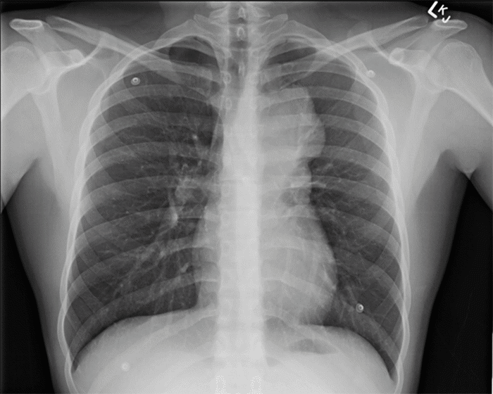 Chamberlain Incision The Chamberlain Procedure to Diagnose Primary Mediastinal Seminoma ...