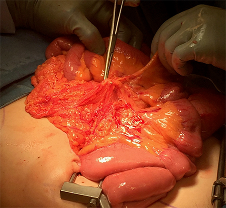 Figure 5. Fibro-fatty bands of tissue which adhered the omentum to the small bowel mesentery. There was no true plane between tissue structures here; it was all abnormally fused.