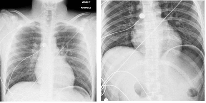 (A) Upright chest radiograph and (B) abdominal radiograph demonstrating free air under the diaphragm, consistent with pneumoperitoneum