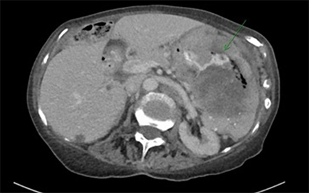 Figure 1. Axial imaging demonstrating oral contrast passing between the stomach and the splenic mass through a fistulous tract