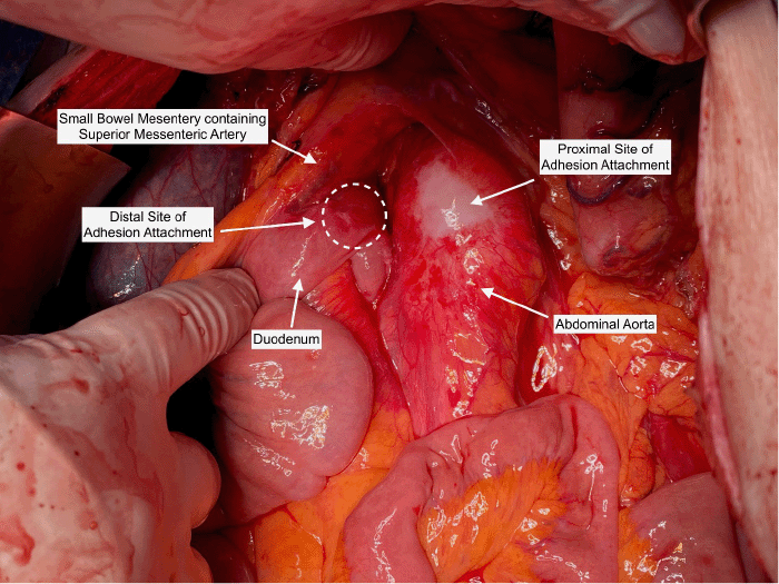 Intraoperative photograph of the upper abdomen following meticulous lysis of adhesions between the transverse duodenum and the underlying calcified abdominal aortic aneurysm. The image demonstrates the freed duodenum now able to fall away from the aneurysm, relieving the extrinsic compression that had caused the obstruction