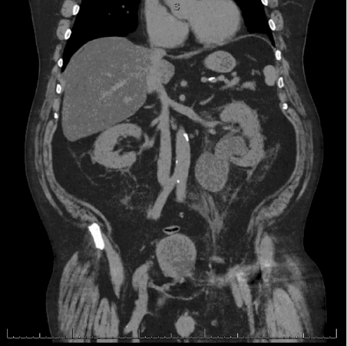 Coronal view demonstrating severe left-sided hydronephrosis and hydroureter proximal to the point of herniation