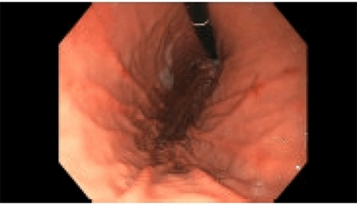 Upper endoscopic view of the gastric body. The image displays diffuse mucosal erythema, friability, consistent with active gastroduodenal inflammation. Subsequent biopsies from these erythematous areas confirmed underlying vasculitis