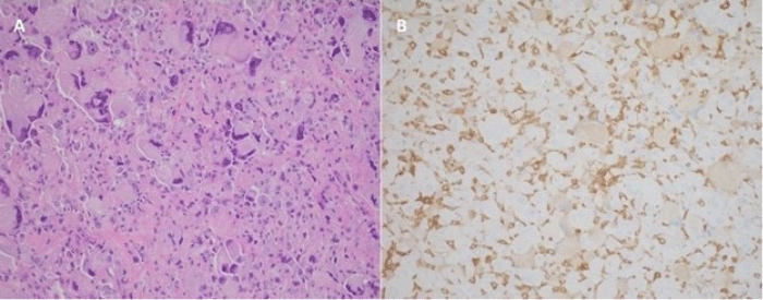 (A) H&E stain (20x original magnification) reveals a highly cellular neoplasm composed of markedly pleomorphic cells with significant variation in cell size and shape. Two mitotic figures are seen in close proximity. (B) Immunohistochemical stain for CD163 (20x original magnification) highlights numerous tumor cells with positive (light brown) cytoplasmic staining, supporting a fibrohistiocytic line of differentiation