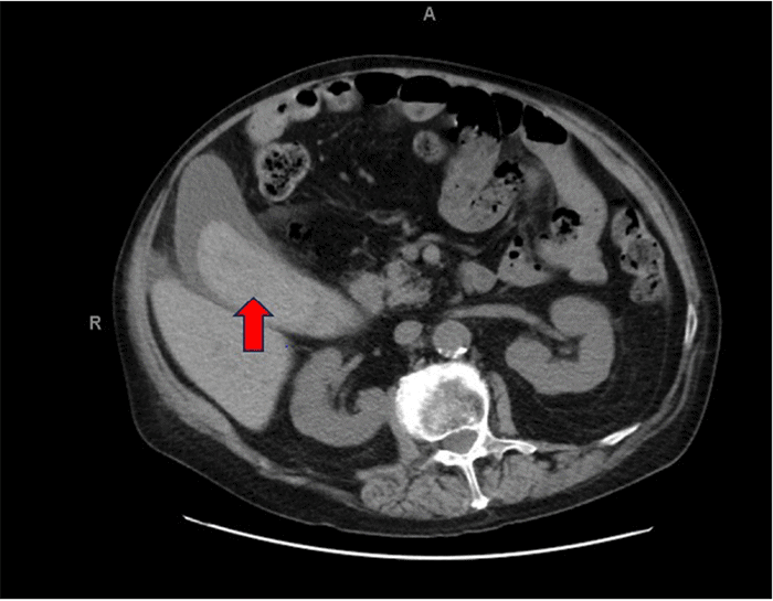 Axial image from a contrast-enhanced CTA of the abdomen, arterial phase. The gallbladder is markedly distended, and its lumen is predominantly occupied by high-attenuating material (red arrow), consistent with an intraluminal blood clot, characteristic of hemorrhagic cholecystitis
