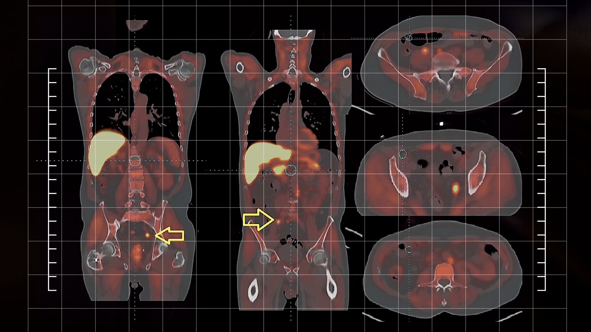 Psma Advanced Imaging, Robotic Surgery Propel Prostate Cancer Management | ACS