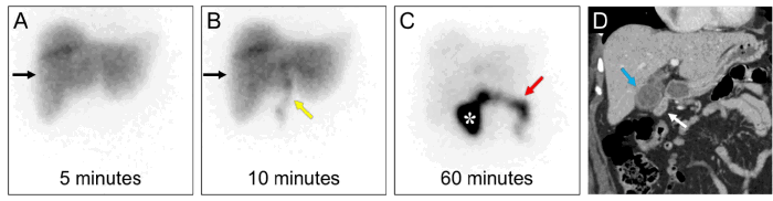 Anterior planar images from HIDA scintigraphy at 5, 10, and 60 minutes postintravenous radiotracer injection (A, B, and C, respectively) demonstrate normal hepatic radiotracer uptake (black arrows), as well as excretion of radiotracer into the common bile duct and small bowel (yellow and red arrows, respectively). Given the proximity of the gallbladder and duodenum seen on a prior CT (D, blue and white arrows, respectively), the uptake near this region on 60 minute images (C, *) is of indeterminate locality