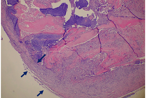 (A) Low-power magnification reveals a lobular, partially cystic lesion with a thick, fibrous capsule (dark blue arrows)