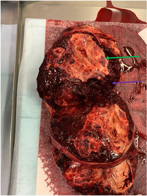 Green arrow: neoplasm; Purple arrow: surrounding hemorrhage within the adrenal