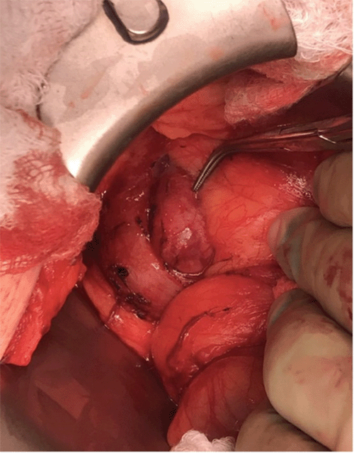 Image obtained just prior to resection via enucleation