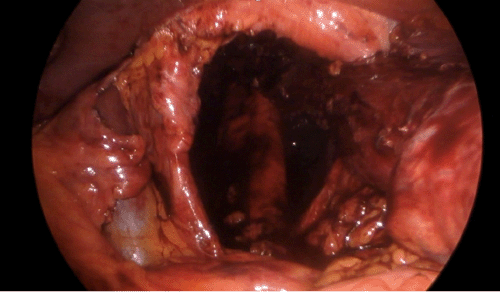 The image provides a clear and full visualization of the large diaphragmatic defect (hiatus) prior to surgical repair
