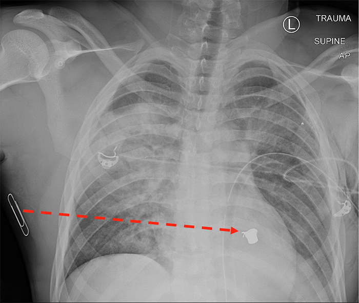 Figure 1: Chest X ray of patient with Transmediastinal gunshot wound. Dotted red line depicts bullet trajectory implied by skin wound (marked by paper clip) and location of bullet on X ray.
