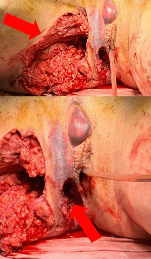 Clinical photographs upon initial presentation. (Top) Superior-lateral view of the right traumatic defect demonstrating exposed pubic ramus, avulsed levator muscles (arrow), and extension into the gluteal musculature and posterior thigh compartment, associated with an open segmental femur fracture. (Bottom) Inferior view showing the disrupted right perineum, including the anterior-right distal rectum and complete avulsion of the anal sphincter complex