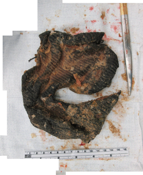 Specimen was removed from stomach and then flattened out. Presumed keyhole for distal esophagus is evident in mesh's center.