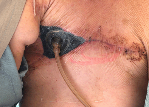 Temporary closure with reverse abdominoplasty/abdominal tissue advancement flap and negative pressure wound therapy