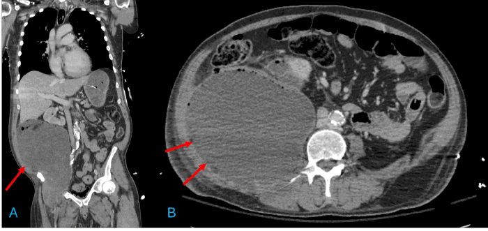 (A) Coronal and (B) axial views from a contrast-enhanced CT scan on presentation. The images reveal a massive, 27.2 × 14.2 × 16.1 cm, multiloculated, rim-enhancing fluid collection in the right retroperitoneum, extending along the iliopsoas musculature and through the femoral canal into the thigh
