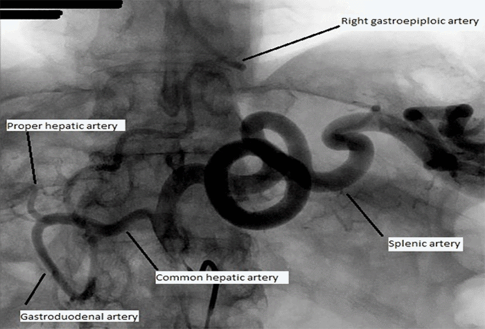 Right gastroepiploic artery is the primary supply to the conduit following prior esophagectomy. Left gastric and short gastric arteries have been ligated. Right gastric artery, though likely patent, is diminutive