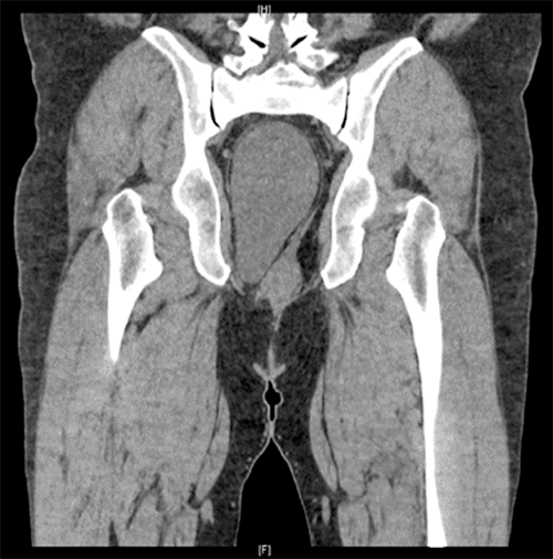 C) CT imaging of pelvis showed large, well-circumscribed oval mass in deep pelvis posterior and lateral to rectosigmoid, which extended into right ischiorectal fossa. Measured 11.9 × 7.5 × 14.9 cm. Internal density of mass was 17 Hounsfield units.