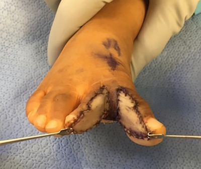 Figure 10. Intraoperative pictures of syndactyly repair of 1st web space.