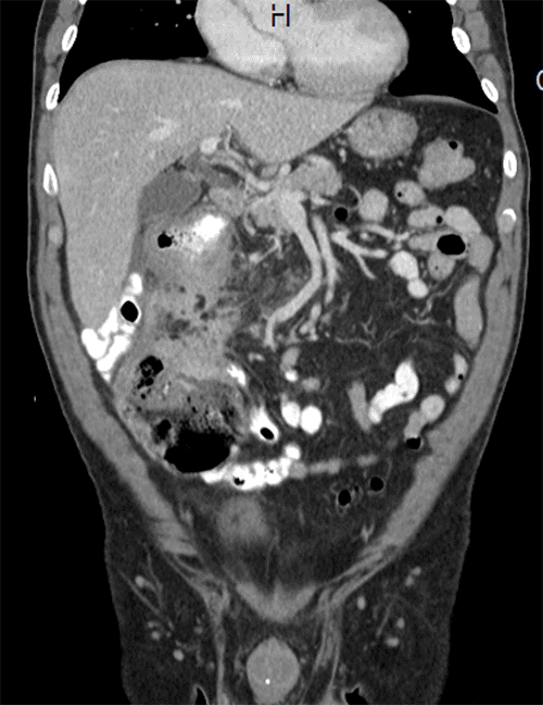 Right-sided colonic mass, increased in size, abutting the IVC and duodenum