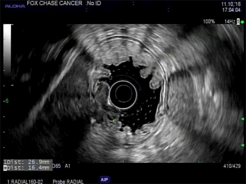 Figure 2. EUS revealed a 27 mm, hypoechoic, lobulated mass in the mid-body consistent with a uT2-3N0M0 tumor.