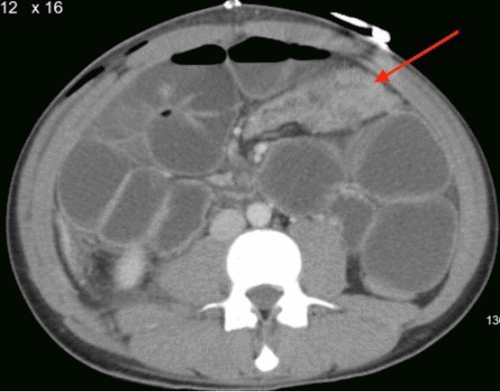 (E) Axial views showing collapsed bowel located distal to the anastomosis