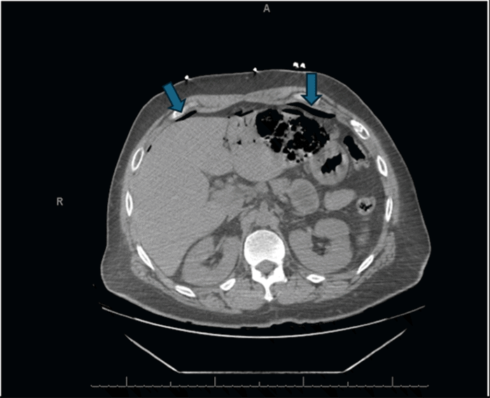 Axial follow-up CT scan of the upper abdomen, highlighting the presence of extraluminal free intraperitoneal air